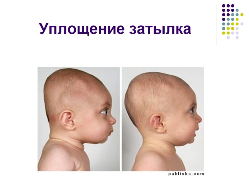 Уплощение затылка